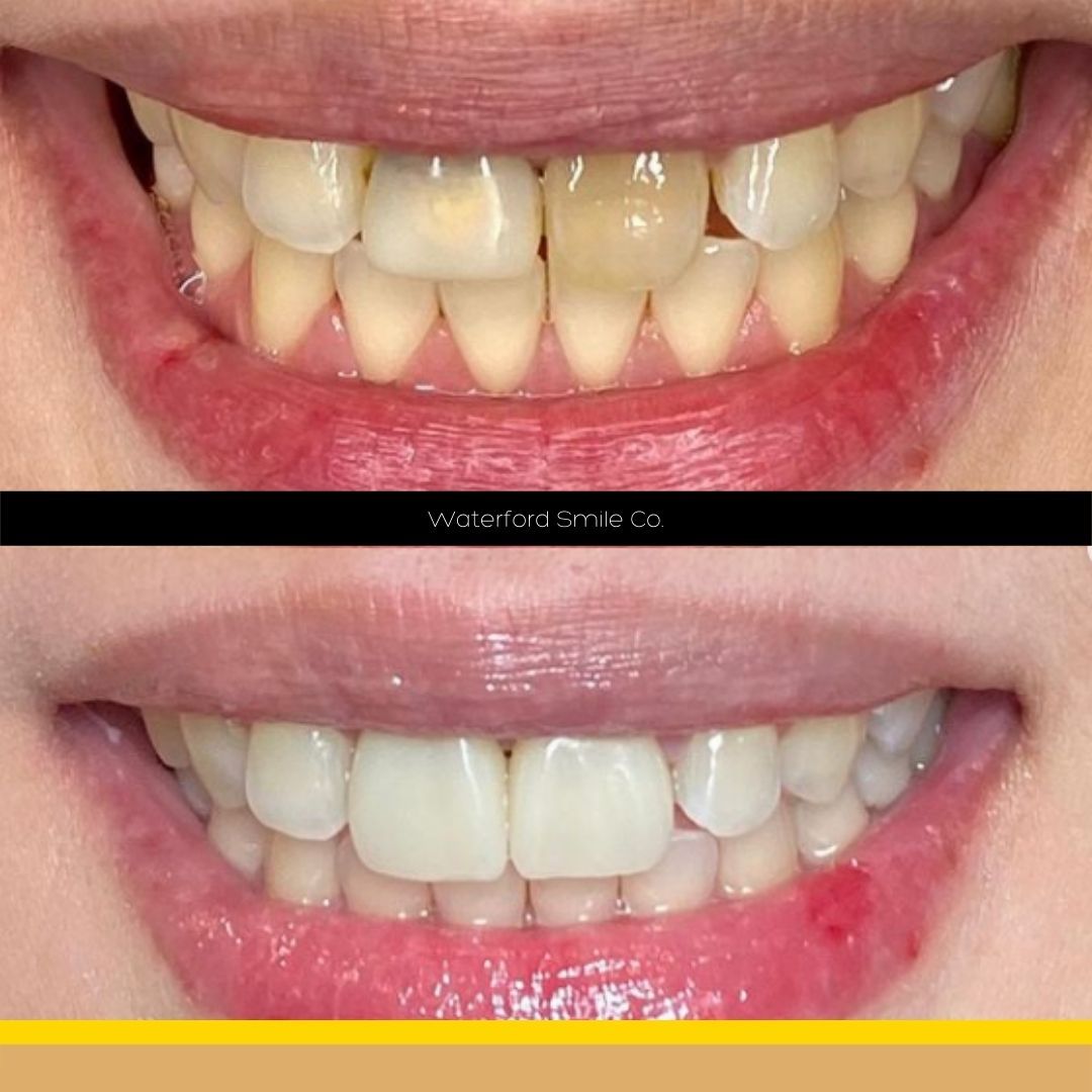 Before and after Smile Makeover treatment